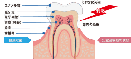 知覚過敏とは？