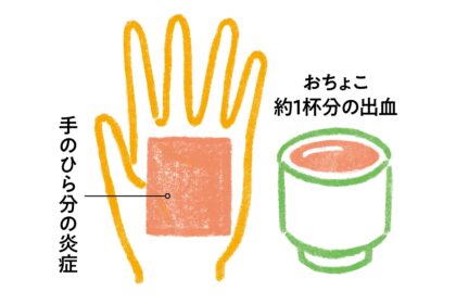 歯周病による全身への影響