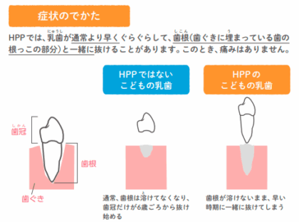 低ホスファターゼ症の特徴