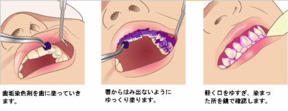 染め出し液