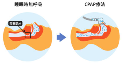 CPAP療法