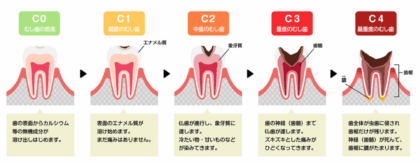 むし歯の進行