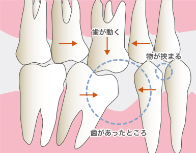 噛み合わせの崩れ