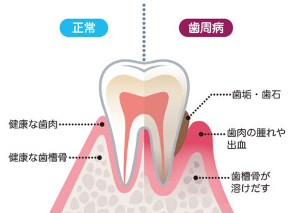 歯周病